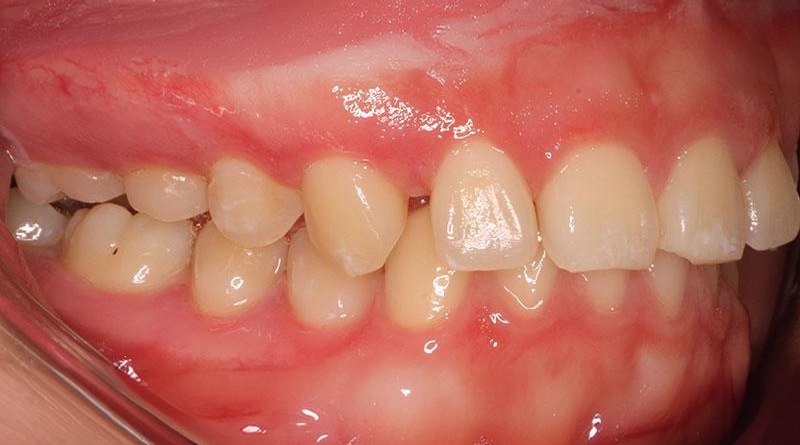 Before treatment - patient 18