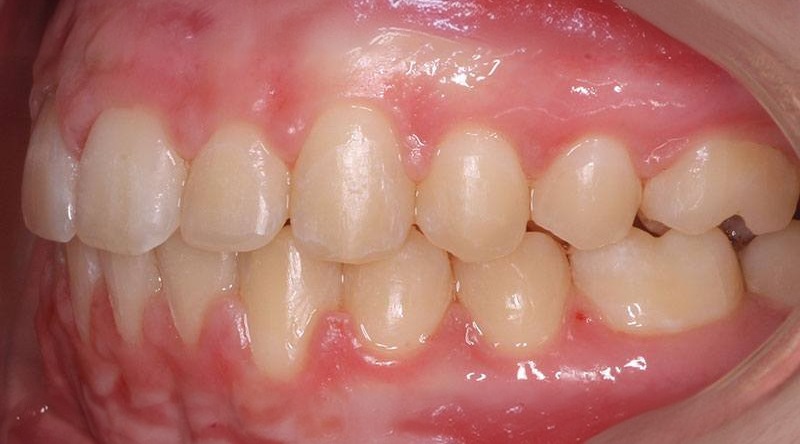 After treatment - patient 16