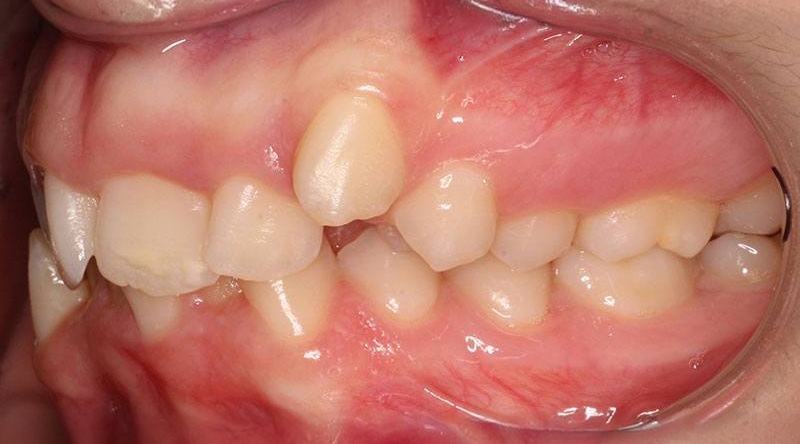 Before treatment - patient 35