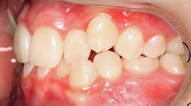 Before treatment - patient 31