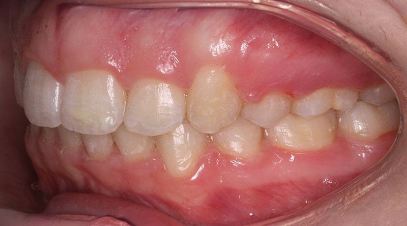 After treatment - patient 35