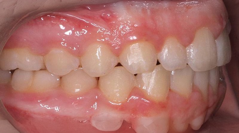 After treatment - patient 23