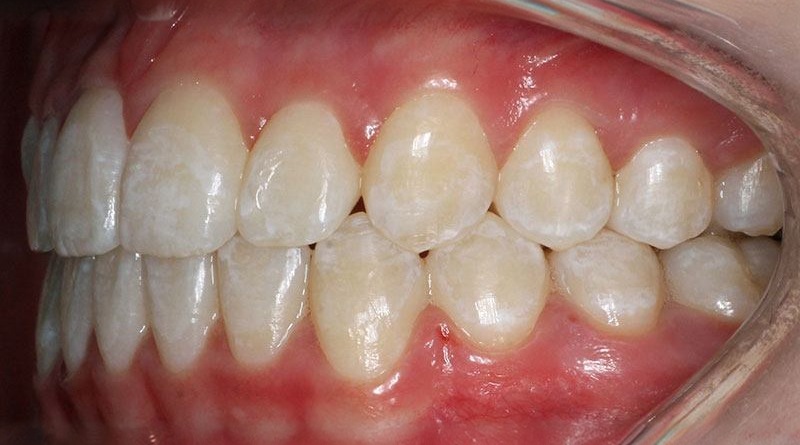 After treatment - patient 31