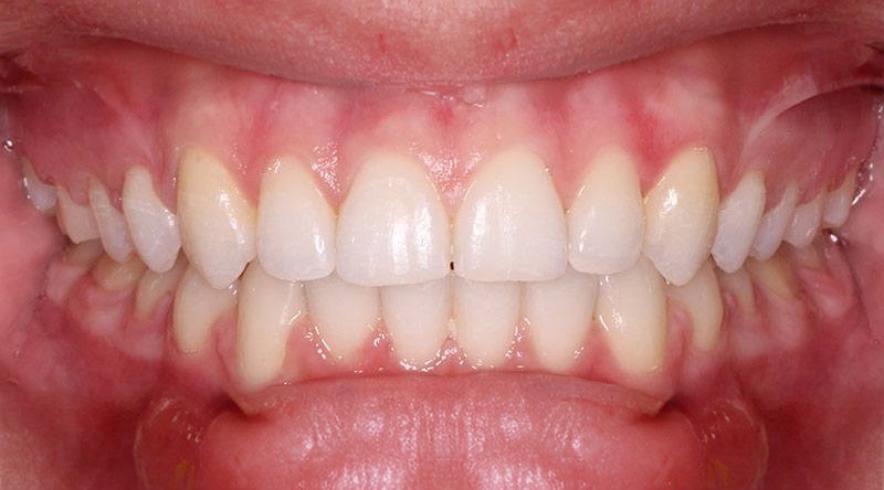 After treatment - patient 10