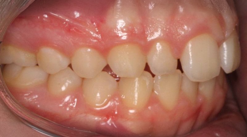 Before treatment - patient 23