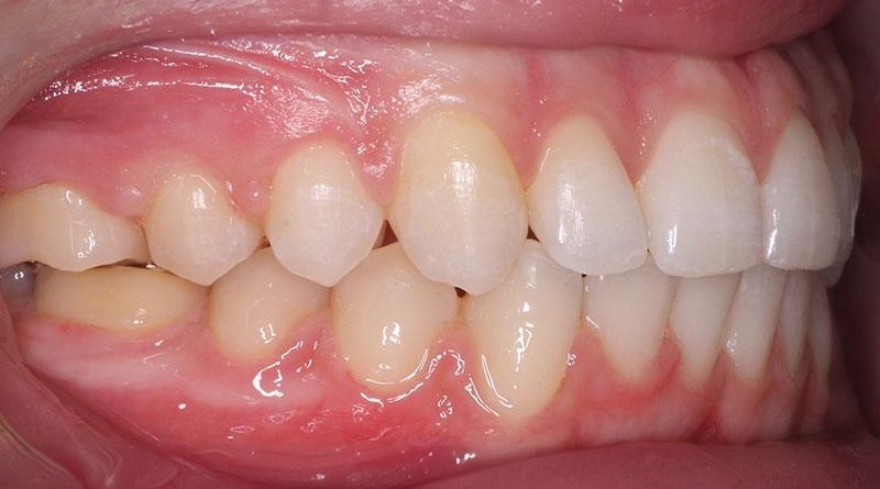 After treatment - patient 11