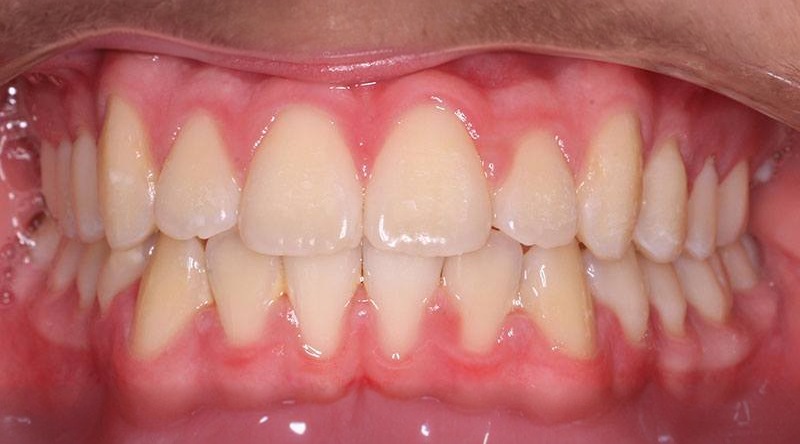 After treatment - patient 8
