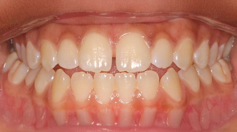 Before treatment - patient 25