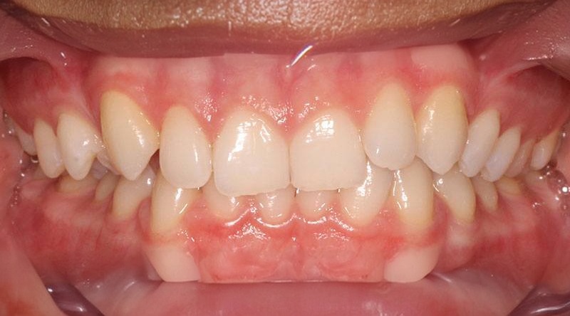 Before treatment - patient 10